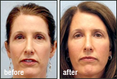 Fat Transfer Before and After Photos